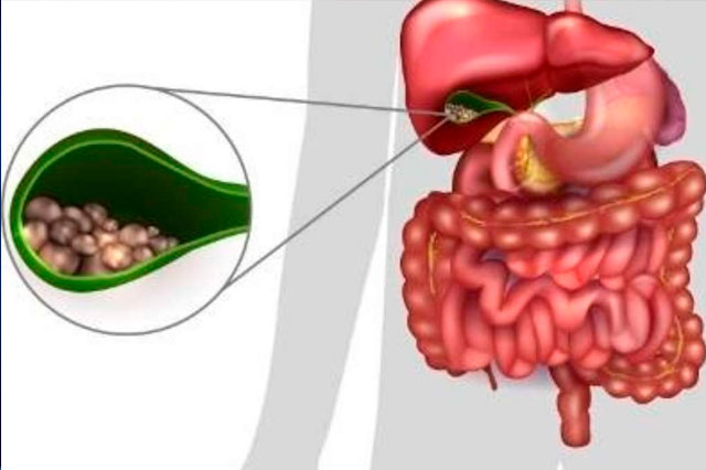 Dr Paulo Ramalho - Cálculos na vesícula biliar