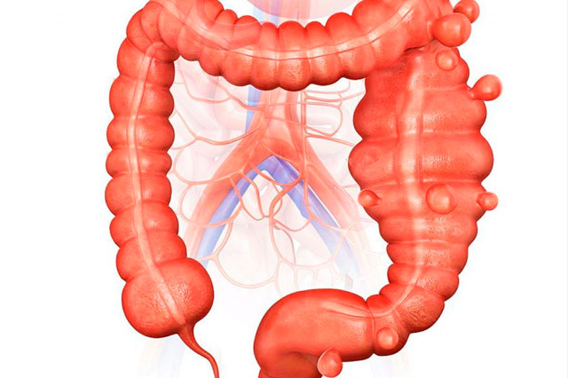 Dr Paulo Ramalho - Diverticulose Cólica